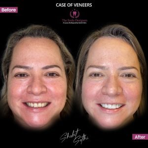 0001.-new-veneers-24b-300x300-1.jpg