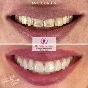 0001.-new-veneers-7-300x300-1.jpg