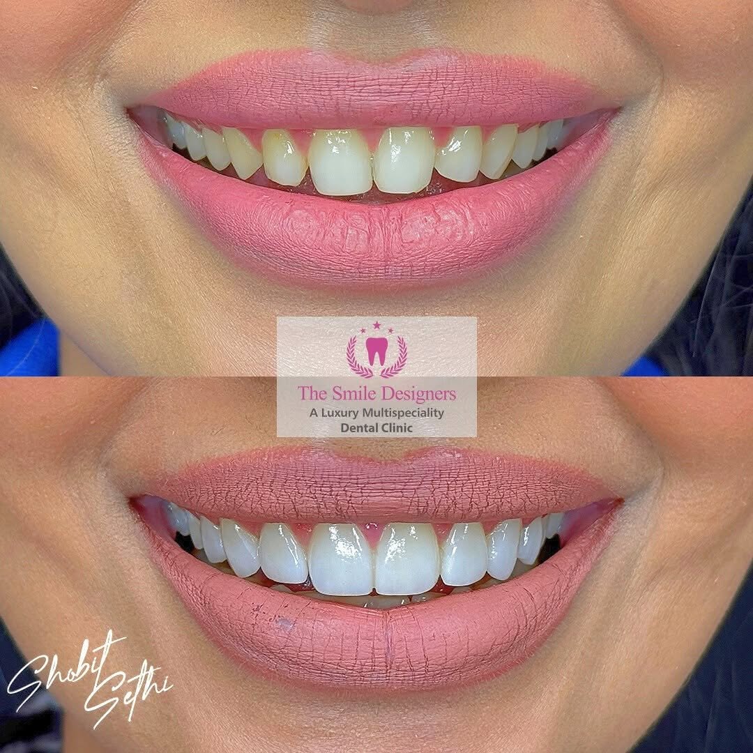 Veeners-best-dentist-in-mohali.jpg