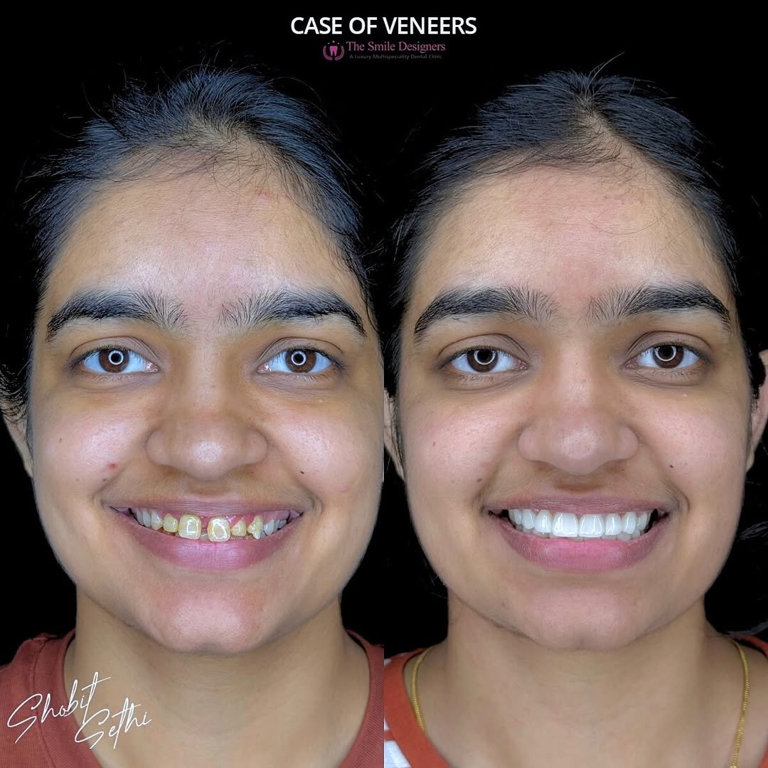 Veneers Treatment in Mohali - The Smile Designers - Best Cosmetic Dentist in Mohali